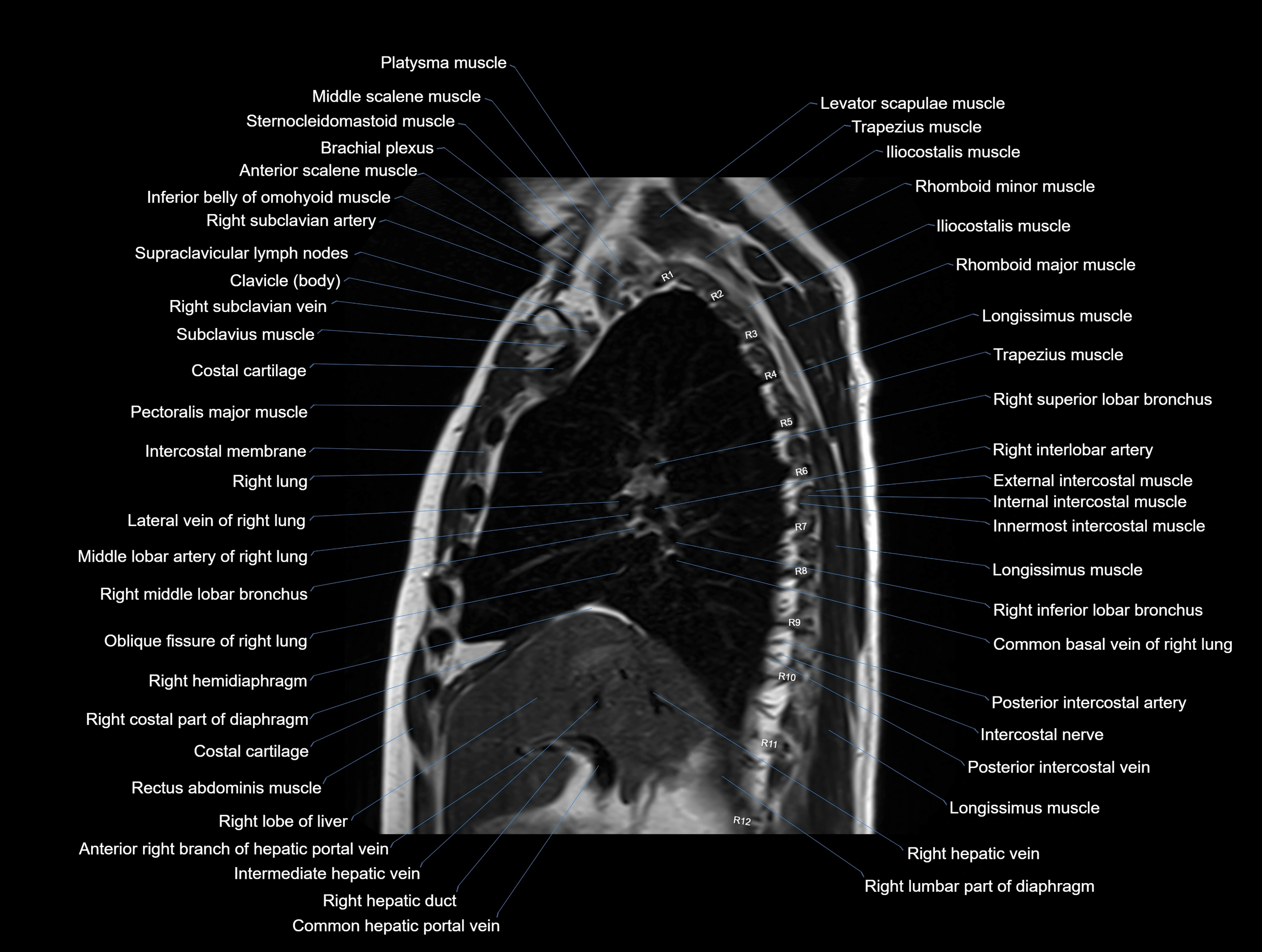 MRI chest (thorax) coronal  cross sectional anatomy 3T radiology  image-img-00001-00015.webp